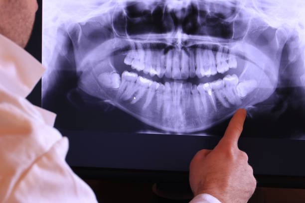 Best Emergency Wisdom Teeth Removal in Bluffton, OH